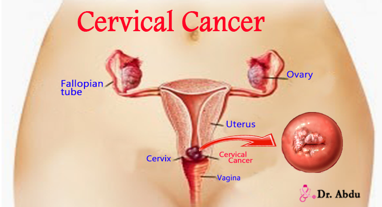 You are currently viewing Cervical Cancer