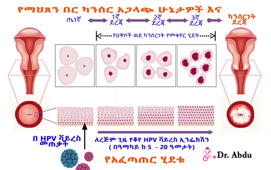 You are currently viewing የማህጸን በር ካንሰር አጋላጭ ሁኔታዎች እና አፈጣጠር ሂደቱ