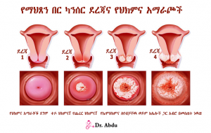 Read more about the article የማህጸን በር ካንሰር ደረጃዎች እና ህክምና አማራጮች