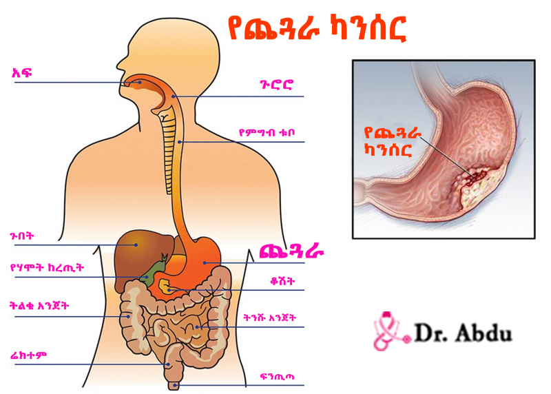 Read more about the article የጨጓራ ካንሰር ምንነት